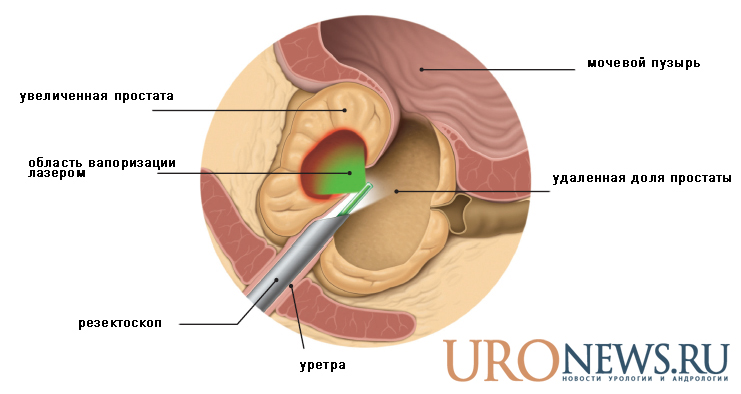 Chirurgie laser verde pentru îndepărtarea adenomului de prostată