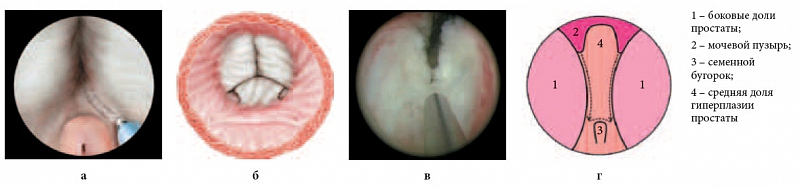 Рис. 2. Первый этап энуклеации. Формирование борозд справа и слева от средней доли гиперплазии простаты: а, б – объемная схема; в – интраоперационная фотография; г – графическая схема