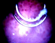 Рисунок № 6. Биполярная электрорезекция стенки мочевого пузыря с опухолью.