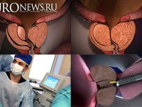 Аденома предстательной железы больших размеров, хирургические методы лечения