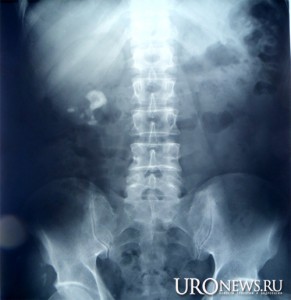Рис. 1. Обзорная рентгенограмма органов мочеполовой системы Визуализируются конкременты лоханки, средней и нижней групп чашечек правой почки.