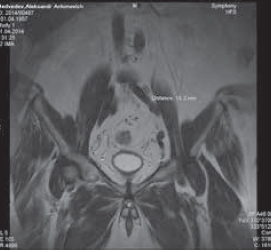 Рис. 2. Пациент М. МР-картина подвздошной лимфаденопатии