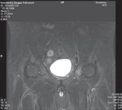 Рис. 5. Пациент Х. МР-картина метастатического поражения ко- стей таза