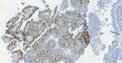 Рис. 7. Протоковый рак папиллярного строения, экспрессия PSA в опу- холевых клетках (опухоль пациента Е.)