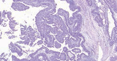 Рис. 6. Протоковый рак папиллярного строения (опухоль пациента Е.)