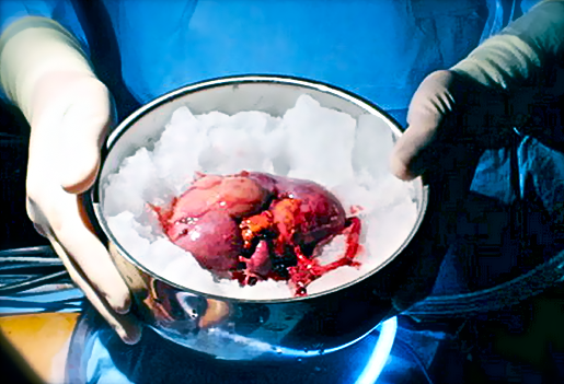 Резекция почки, выполненная вне организма оперируемого