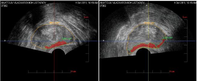 Гистосканирование простаты (Фото) сагиттальная и поперечная получаются при ультразвуковом сканировании аппаратом pro-focus фирмы BK-Medical