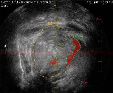 Рисунок 4 - Гистосканироание простаты (фото) Виртуальная плоскость простаты – фронтальная (краниальная)