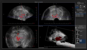 Гистосканирование — метод диагностики рака предстательной железы.