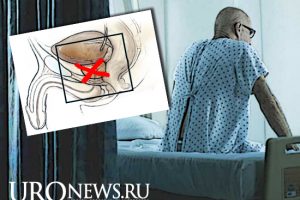 Качество эрекции и удовлетворенность половым актом после радикальной простатэктомии