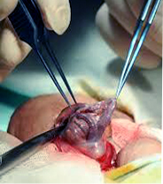 Операция Мармара при варикоцеле. Этап выделения и пересечения сосудов (вен)