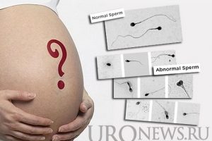 Влияние морфологии сперматозоидов на вероятность невынашивания беременности