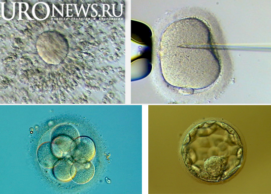 Влияние фрагментации ДНК  сперматозоидов на ранние этапы эмбрионального развития при ЭКО